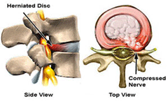 diagram of herniated disc pressing on nerve, causing radiculopathy